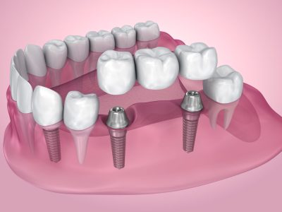implant supported fixed bridge. Transparent view . Medically accurate 3D illustration