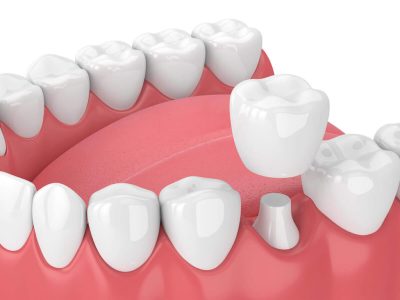 dental-crown-bridge-dental-service-1024x768