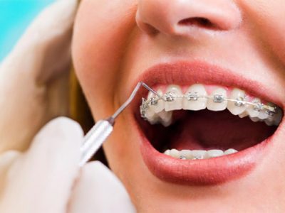 what-is-accelerated-orthodontics-outstanding-ortho-blog